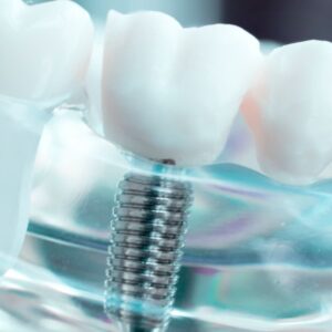 implantes dentales