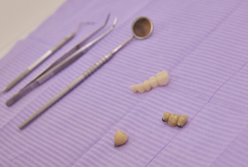 implantes dentales