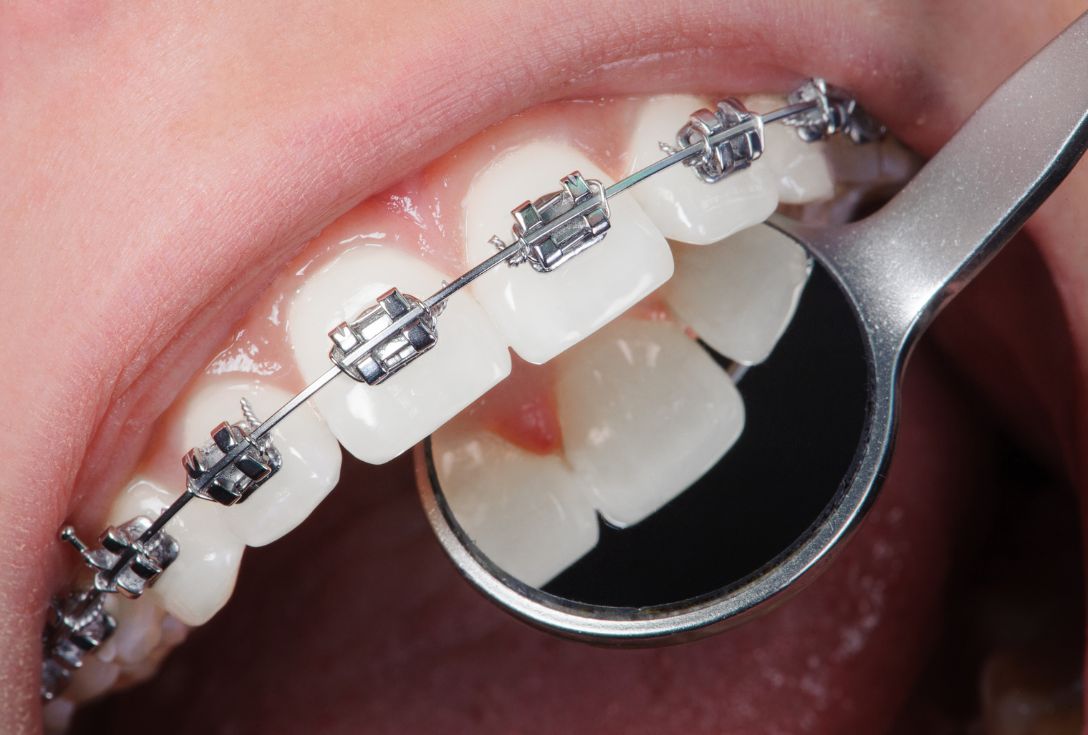 ¿Se Puede Hacer Ortodoncia Si Tienes Periodontitis?