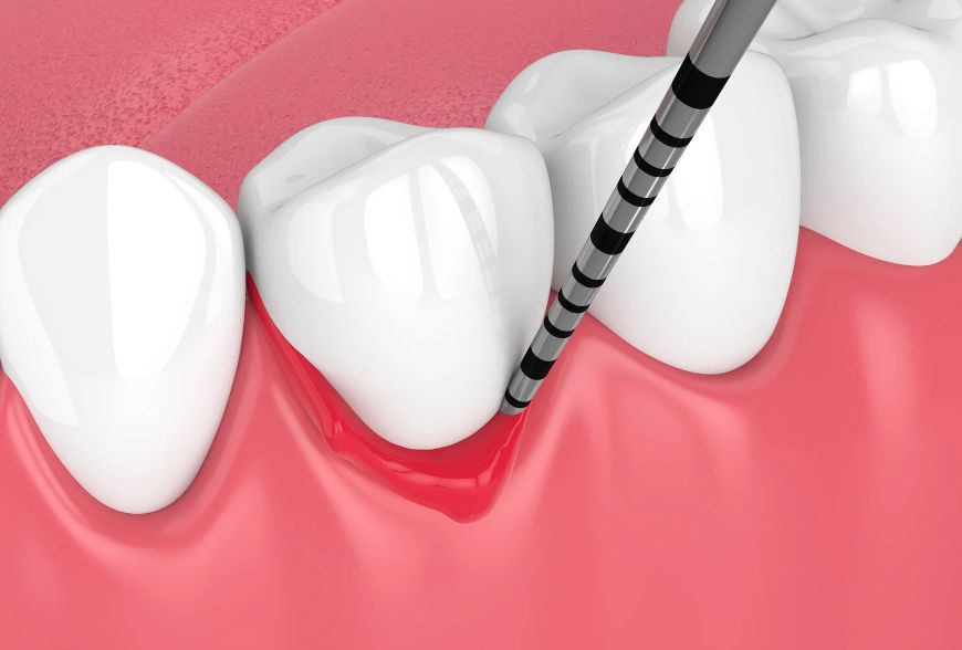 Periodontitis