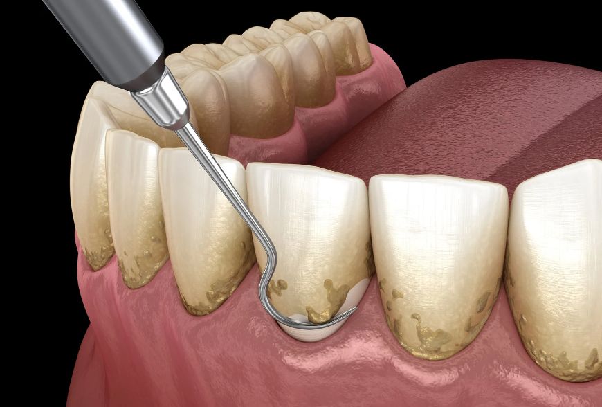 ¿Cuándo Se Estabiliza La Periodontitis?